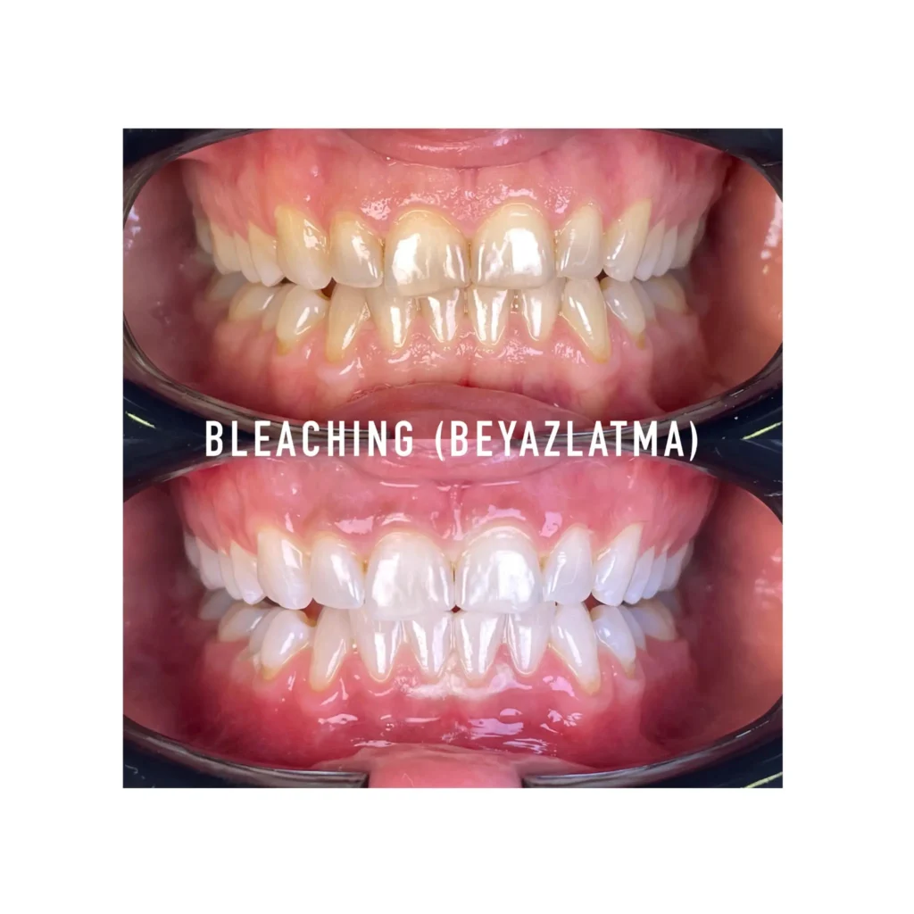 Diş Beyazlatma (Bleaching)