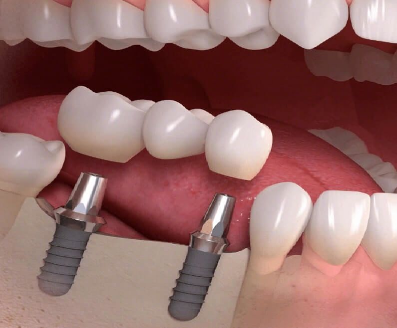 Kısa implant